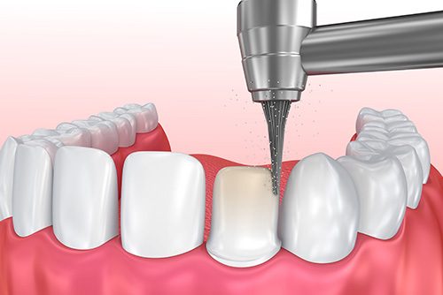 Dental Veneer Procedure